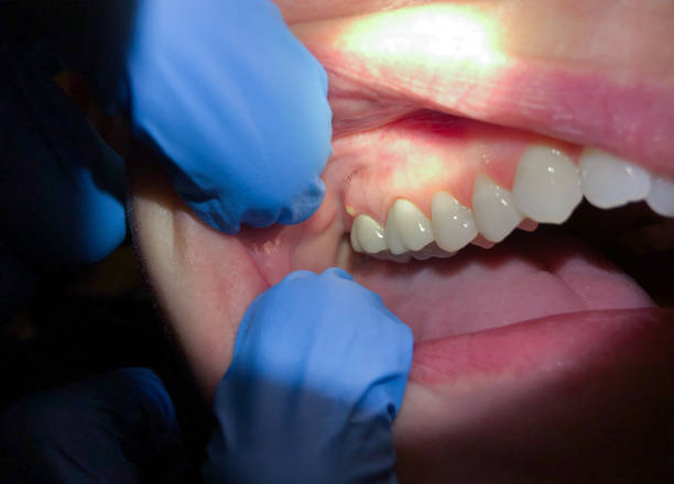 Best Emergency Root Canal Therapy in Preston, TX